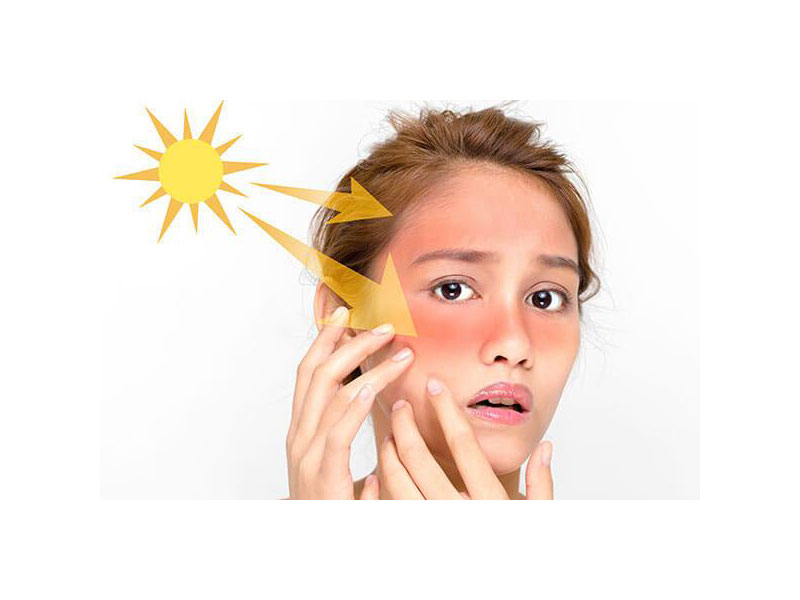 درمان حساسیت به نور خورشید