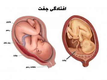 1577906674-placental-abruption.jpg