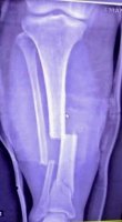 آلبوم تصاویر شکستگی دوبل ساق - 1291