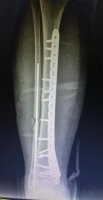 آلبوم تصاویر شکستگی دوبل ساق - 1292